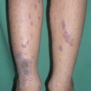 Lichen Planus Ayurvedic Herbal Treatment