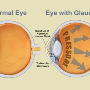 Glaucoma Ayurvedic Natural Herbal Remedies