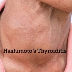 Hashimoto's Thyroiditis Disease Ayurvedic Herbal Treatment
