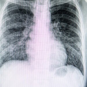 Interstitial Lung Disease ILD Ayurvedic Herbal Remedies