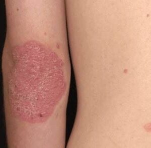 Psoriasis Ayurvedic Herbal Treatment
